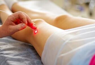 Tratamento a laser de varizes