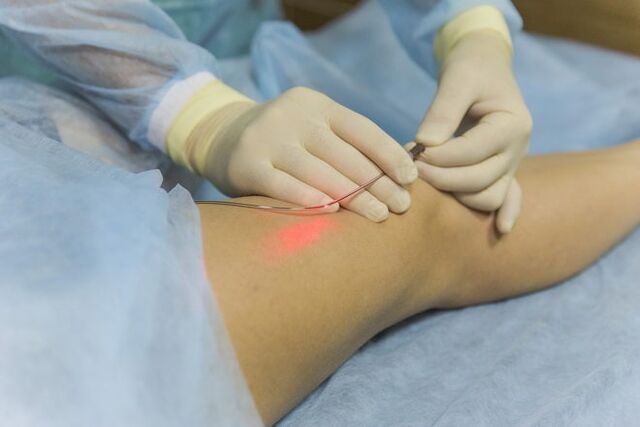 Tratamento a laser de varizes