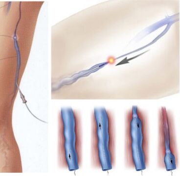 método de tratamento de varizes - coagulação endovenosa a laser