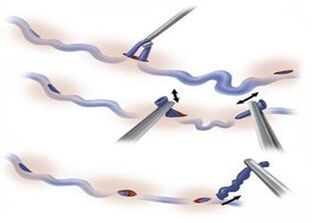 método de tratamento de varizes - miniflebectomia