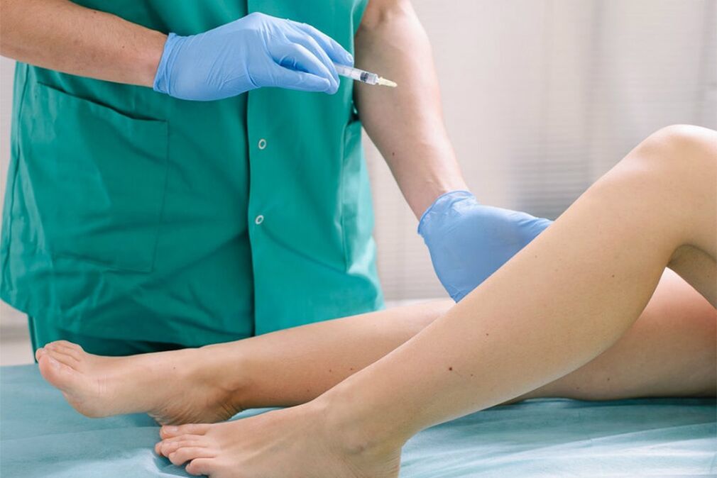 escleroterapia para remoção de varizes