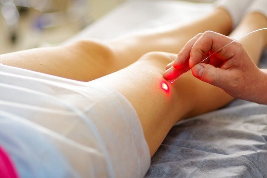 tratamento a laser para varizes