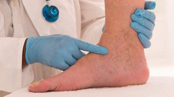 médico examinando pernas com varizes