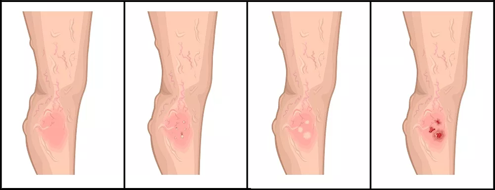 Estágios de desenvolvimento de úlceras tróficas em patologia venosa