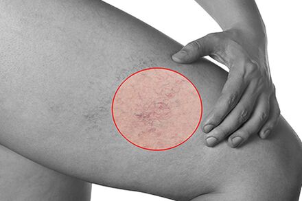 Telangiectasia em varizes dos membros inferiores